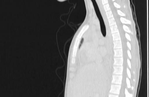 Bronchial mucoepidermoid carcinoma (Radiopaedia 57023-63895 Sagittal lung window 73).jpg