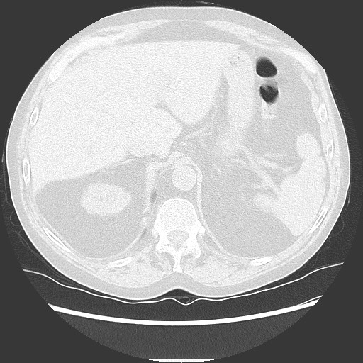 Bronchial stenosis - lung transplant (Radiopaedia 73133-83848 Axial lung window 57).jpg