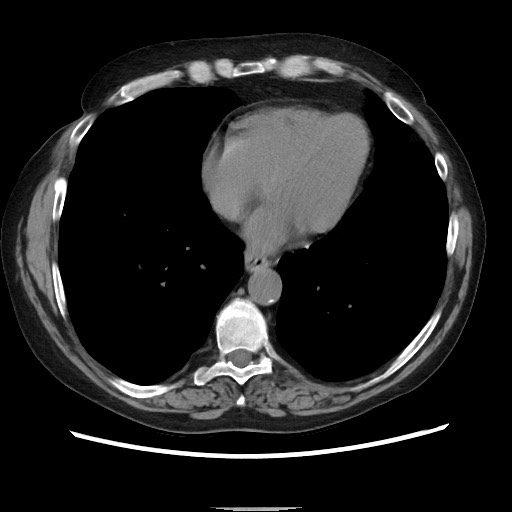 File:Bronchial stenosis - lung transplant (Radiopaedia 73133-83848 Axial non-contrast 43).jpg