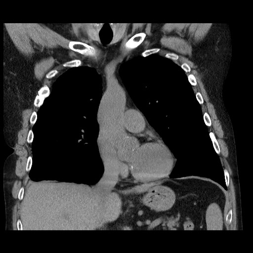 Bronchial stenosis - lung transplant (Radiopaedia 73133-83848 Coronal non-contrast 30).jpg