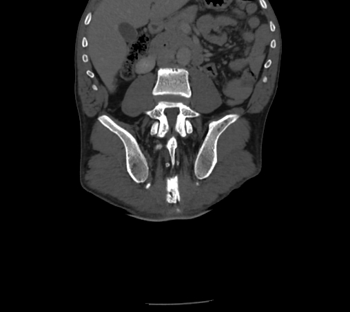 File:Bronchiectasis in Crohn disease (Radiopaedia 60311-67977 Coronal bone window 53).jpg