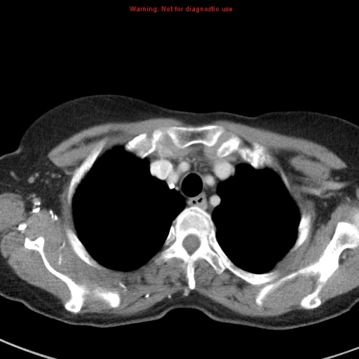 File:Bronchoalveolar carcinoma (BAC) (Radiopaedia 13436-13392 B 9).jpg