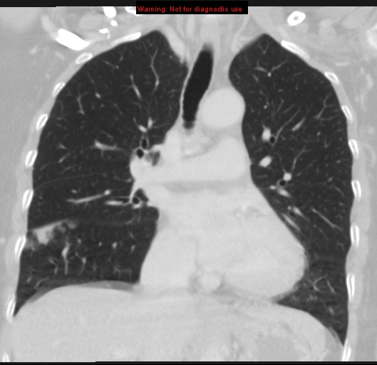 Bronchoalveolar carcinoma (BAC) (Radiopaedia 13436-13392 Coronal lung window 27).jpg