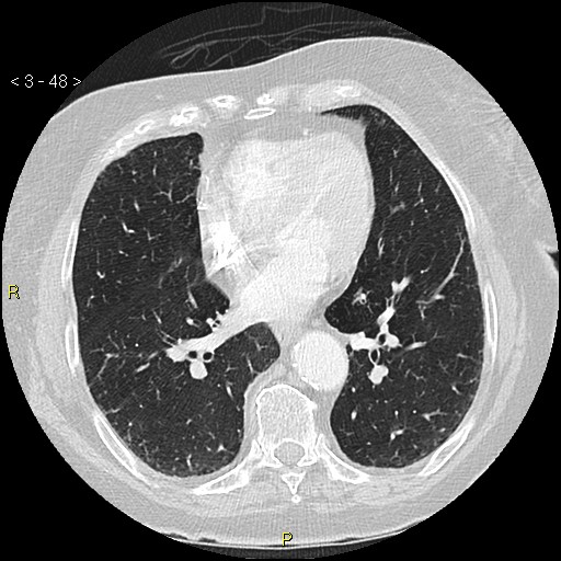 Bronchogenic carcinoma as an incidental finding (Radiopaedia 16453-16130 Axial lung window 48).jpg