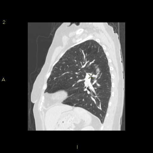 File:Bronchogenic carcinoma as an incidental finding (Radiopaedia 16453-16130 Sagittal lung window 17).jpg