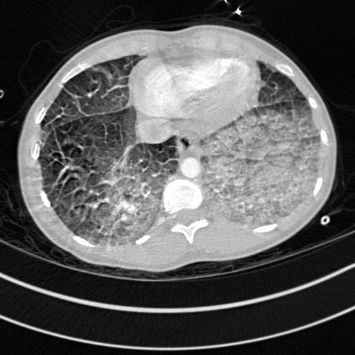 Bronchogenic cyst (Radiopaedia 77801-90071 Axial lung window 69).jpg
