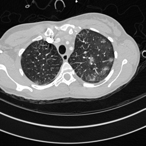 Bronchogenic cyst (Radiopaedia 77801-90071 Axial lung window 7).jpg