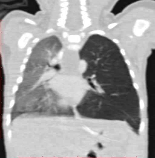 Bronchogenic cyst (Radiopaedia 78599-91409 Coronal lung window 135).jpg