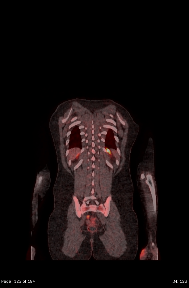 Brown fat uptake (FDG PET-CT) (Radiopaedia 77392-89513 Fused coronal 81).jpg