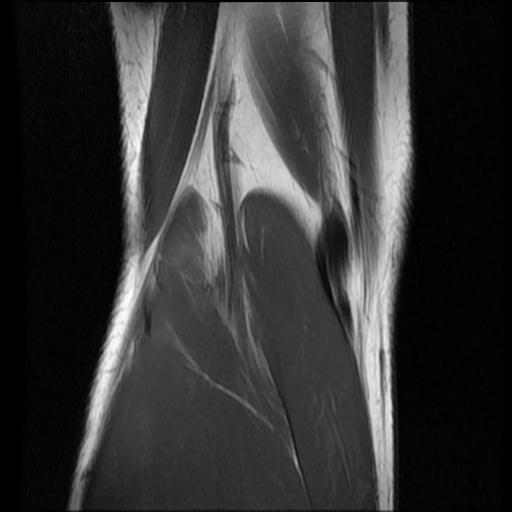 File:Bucket handle tear - lateral meniscus (Radiopaedia 72124-82634 Coronal T1 16).jpg