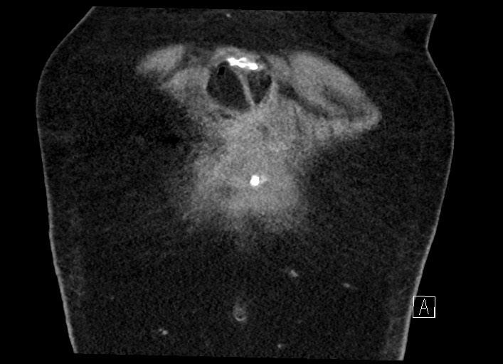 Buried bumper syndrome - gastrostomy tube (Radiopaedia 63843-72577 Coronal Inject 16).jpg