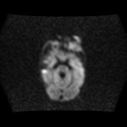 File:Burkitt lymphoma of the orbit- pre and post chemotherapy (Radiopaedia 31214-31929 Axial DWI 4).jpg