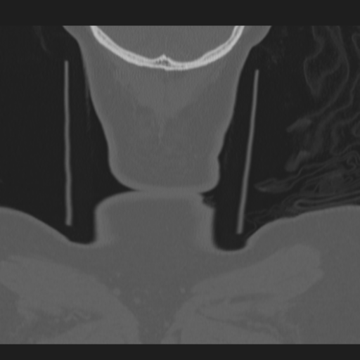 C2 fracture (Radiopaedia 34091-35341 Coronal bone window 68).png