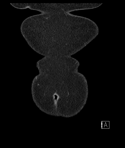 Calcified adrenal glands and Spigelian hernia (Radiopaedia 49741-54988 B 5).jpg