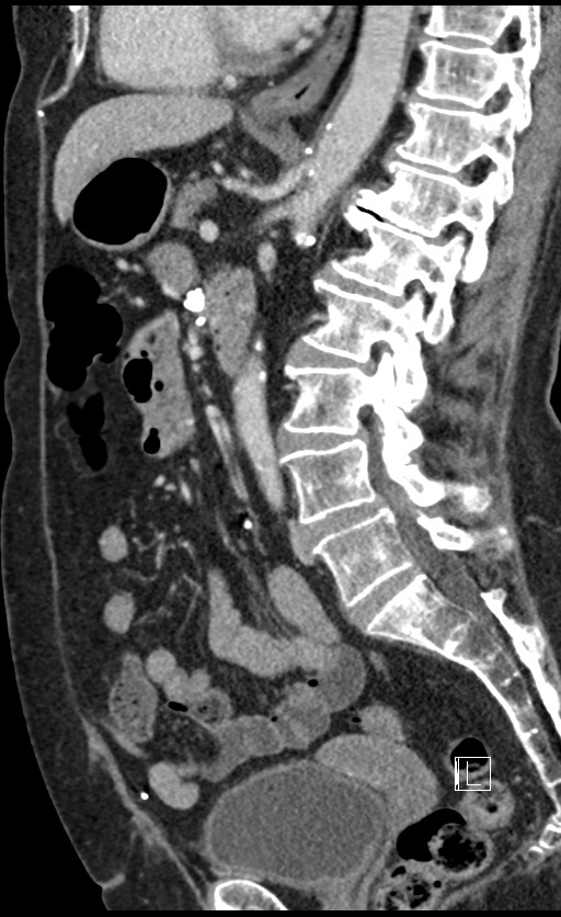 Calcified adrenal glands and Spigelian hernia (Radiopaedia 49741-54988 C 77).jpg