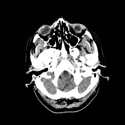 Calcified cerebral hydatid cyst (Radiopaedia 65603-74717 Axial non-contrast 3).jpg