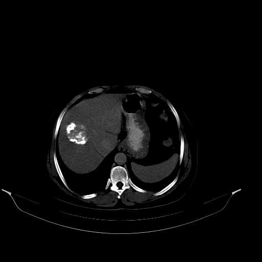 File:Calcified hydatid cyst of the liver (Radiopaedia 21212-21112 Axial bone window 11).jpg