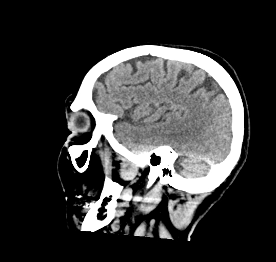 File:Calcified meningioma (Radiopaedia 74361-85243 D 18).jpg