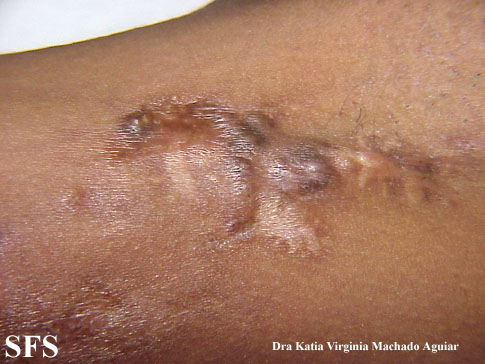 Calcinosis Circumscripta-Idiopathic (Dermatology Atlas 3).jpg