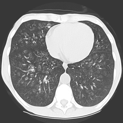 File:Calciphylaxis and metastatic pulmonary calcification (Radiopaedia 10887-11317 Axial lung window 33).jpg