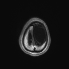 Callosal dysgenesis with interhemispheric cyst (Radiopaedia 53355-59335 Axial T1 148).jpg