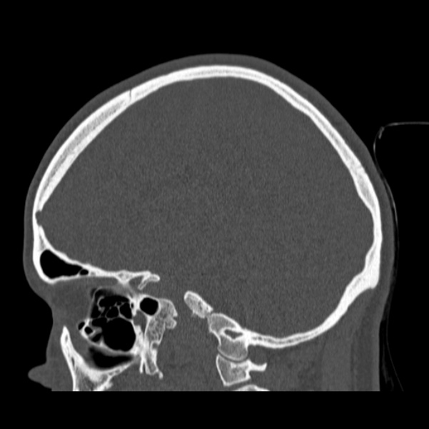 Calvarial osteoma (Radiopaedia 36520-38079 Sagittal bone window 65).jpg