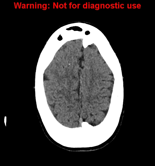 File:Calvarial thickening from chronic shunting (Radiopaedia 60079-67637 Axial non-contrast 24).jpg