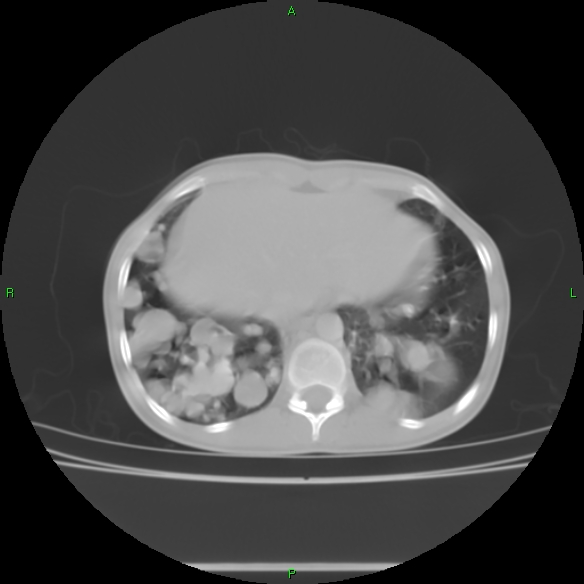 File:Cannon ball metastases - synovial sarcoma (Radiopaedia 26135-26271 Axial lung window 30).jpg