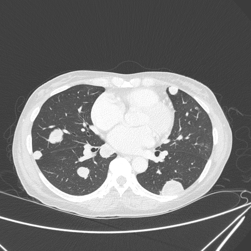 Canonball lung metastasis (Radiopaedia 77634-89837 Axial lung window 102).jpg