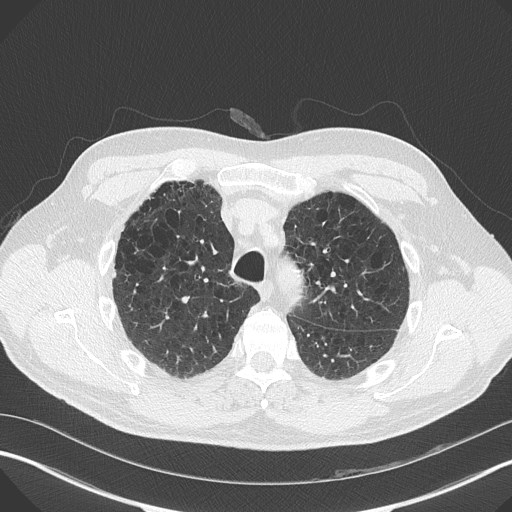 Caplan syndrome (Radiopaedia 56667-63530 Axial lung window 57).jpg