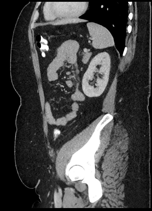 Carcinoid tumor - terminal ileum (Radiopaedia 60931-68739 C 23).jpg