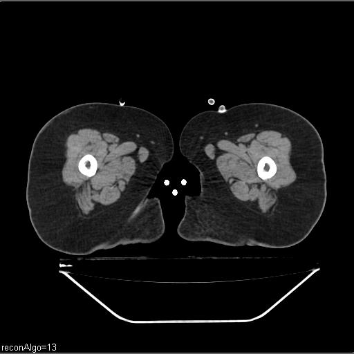 File:Carcinoma cervix- brachytherapy applicator (Radiopaedia 33135-34173 Axial non-contrast 73).jpg