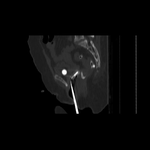 Carcinoma cervix- brachytherapy applicator (Radiopaedia 33135-34173 Sagittal bone window 105).jpg
