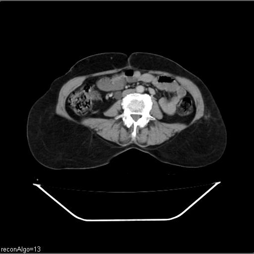 Carcinoma cervix- recurrence (Radiopaedia 34702-36137 B 31).jpg