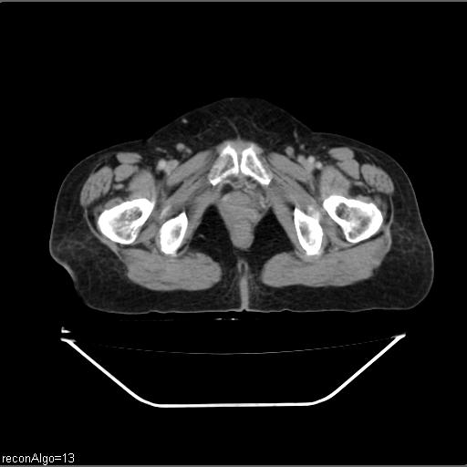Carcinoma cervix- recurrence (Radiopaedia 34702-36137 B 53).jpg