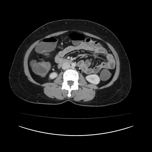 Carcinoma colon - hepatic flexure (Radiopaedia 19461-19493 A 63).jpg