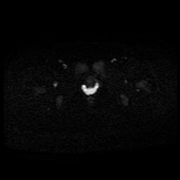 Carcinoma of the cervix (Radiopaedia 89018-105858 Axial DWI 28).jpg