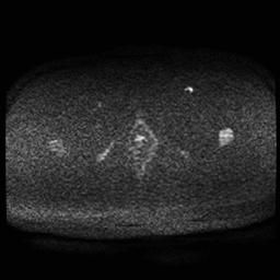 Carcinoma of the cervix (Radiopaedia 89018-105858 Axial DWI 64).jpg