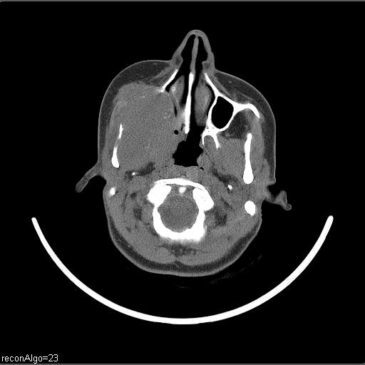 Carcinoma of the maxillary antrum (Radiopaedia 53805-59888 Axial non-contrast 57).jpg