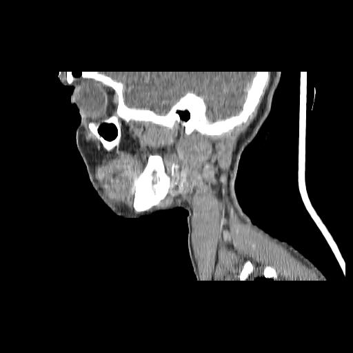 Carcinoma of the maxillary antrum (Radiopaedia 53805-59888 Sagittal C+ delayed 139).jpg
