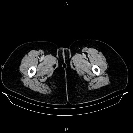 Carcinoma of uterine cervix (Radiopaedia 85861-101700 A 83).jpg