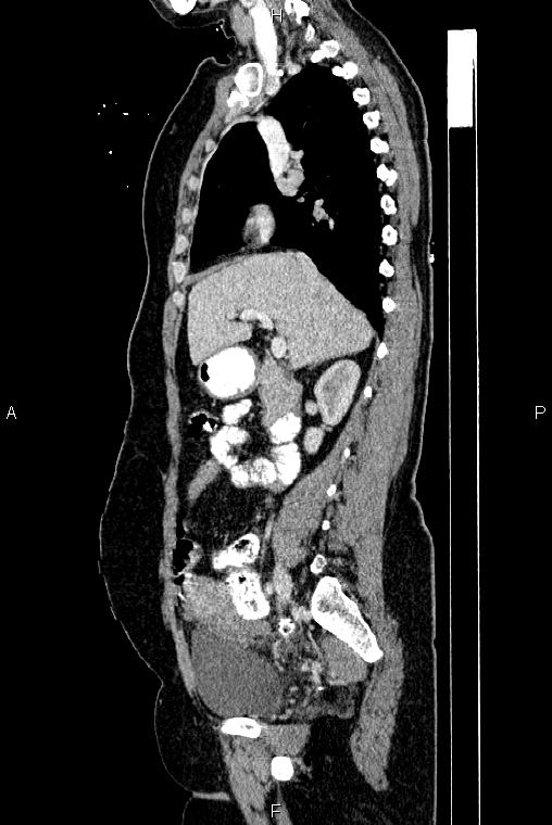 Carcinoma of uterine cervix (Radiopaedia 85861-101700 D 30).jpg