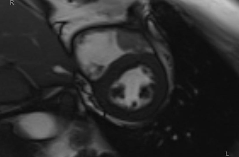 Cardiac hemangioma (Radiopaedia 31709-32631 Short axis Cine SSFP 18).jpg