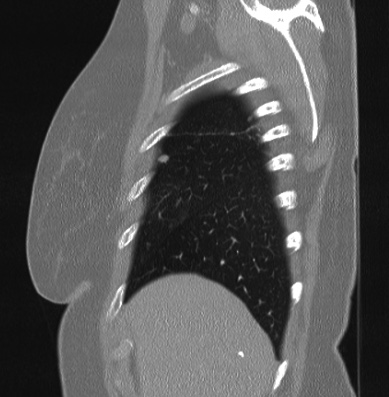Cardiac sarcoidosis (Radiopaedia 74548-85534 Sagittal lung window 81).jpg