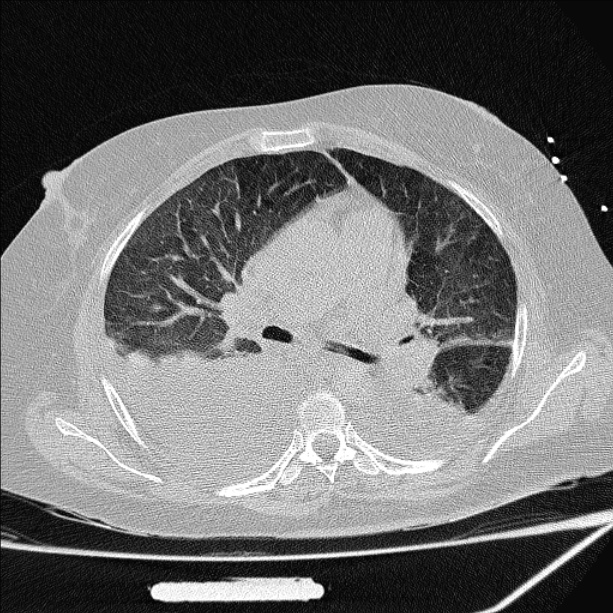 Cardiogenic pulmonary edema (Radiopaedia 29213-29609 Axial lung window 40).jpg