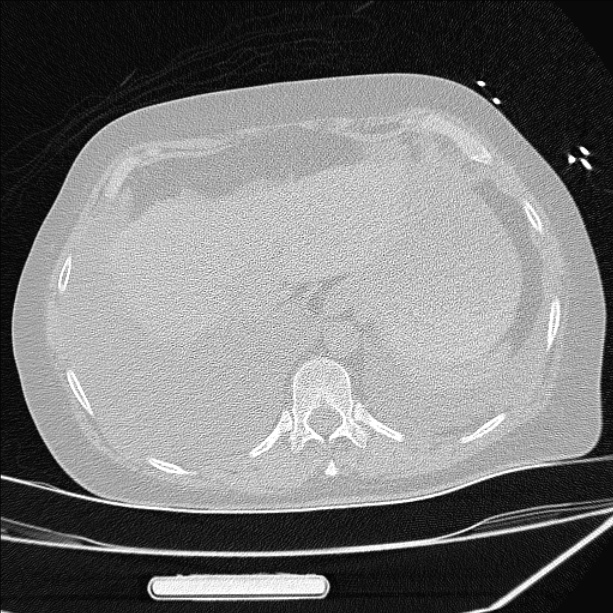 Cardiogenic pulmonary edema (Radiopaedia 29213-29609 Axial lung window 91).jpg