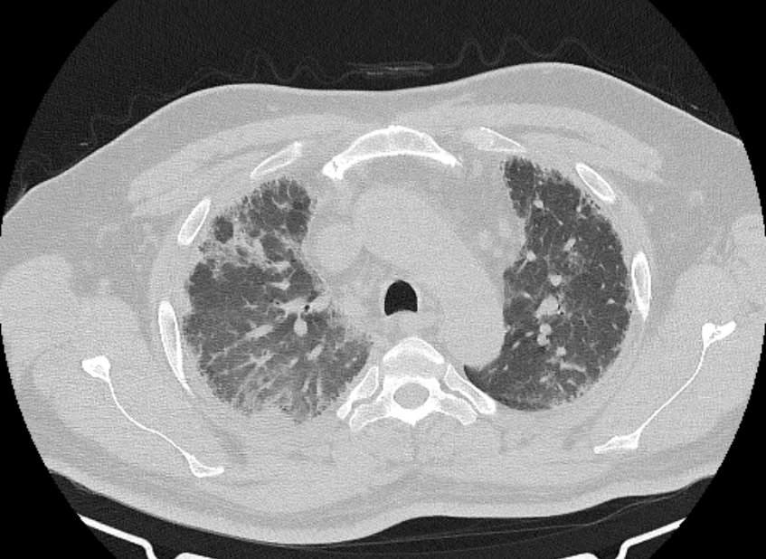 Cardiogenic pulmonary edema (Radiopaedia 68180-77678 Axial lung window 23).jpg