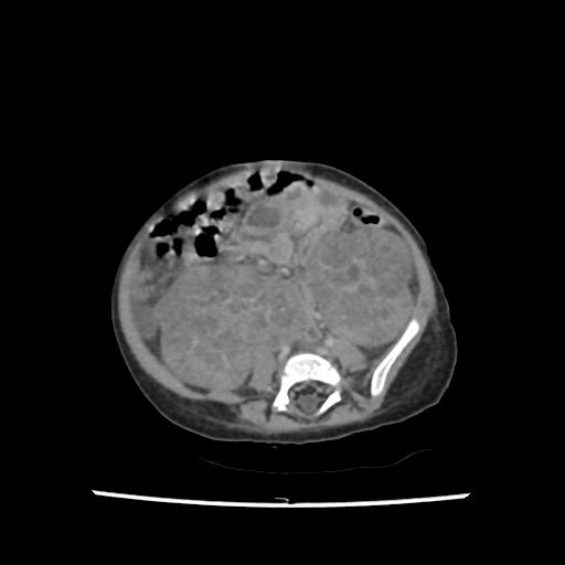 Caroli disease with autosomal recessive polycystic kidney disease (ARPKD) (Radiopaedia 89651-106703 B 155).jpg