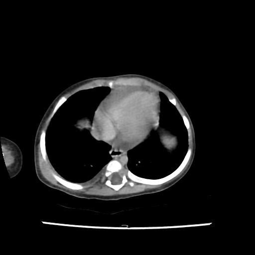 Caroli disease with autosomal recessive polycystic kidney disease (ARPKD) (Radiopaedia 89651-106703 B 8).jpg
