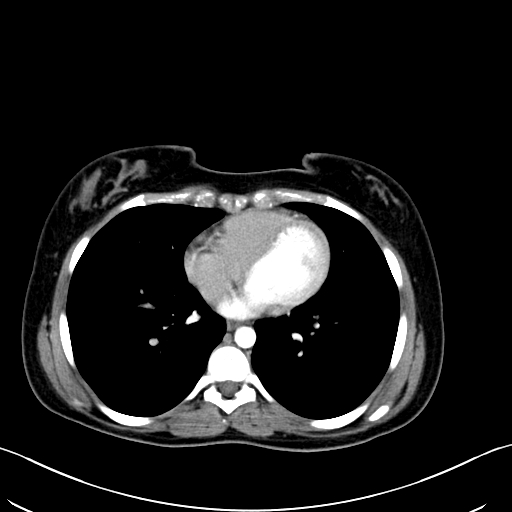File:Caroli disease with medullary sponge kidney (Radiopaedia 82622-96804 C 4).jpg